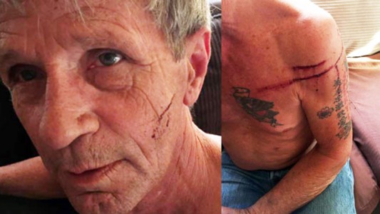 Así quedó el ex boxeador que se peleó con un oso en el bosque