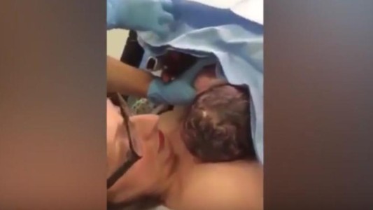 #EsViral El Impresionante video que muestra nacimiento de un bebé por cesárea "natural"
