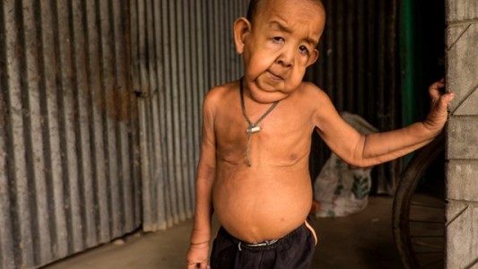 Bangladesh: la historia del nene que tiene 4 años pero parece una persona de 80