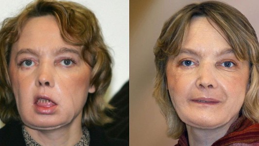 Murió la mujer francesa que recibió el primer trasplante de cara del mundo