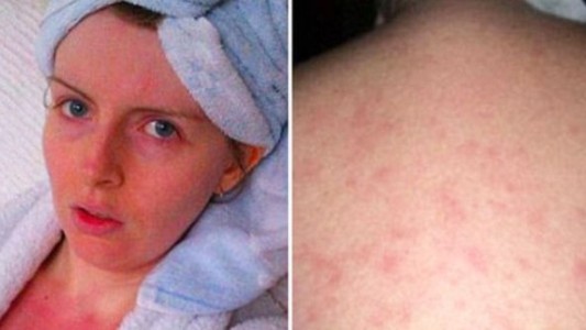 La historia de la mujer que no se puede bañar porque tiene alergia al agua