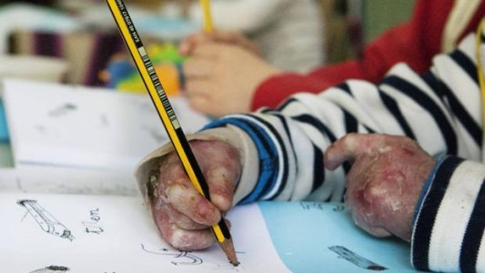 Relato desgarrador: el nene que tiene piel de mariposa y tenía terror a que lo rocen en el colegio