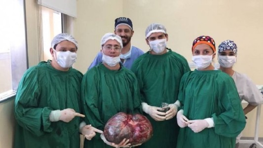 Catamarca: extirparon un tumor de 15 kilos a una mujer