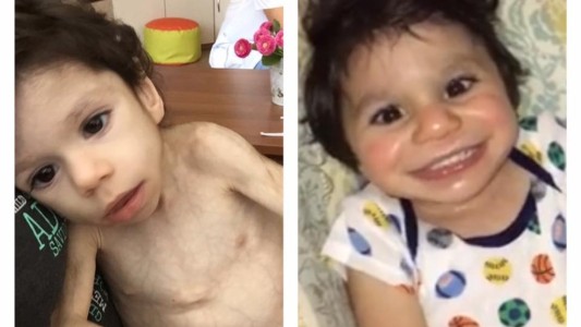 La increible recuperación de un nene de 7 años que pesaba 3 kilos y fue adoptado