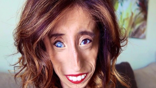 Una mujer con una enfermedad rara encuentra su cara en un cruel meme: su respuesta en Facebook