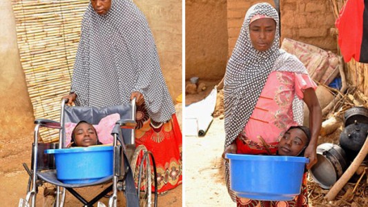 Murió la joven sin cuerpo que vivía en un balde