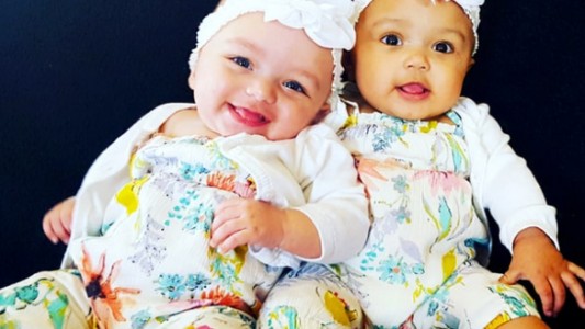 Son gemelas, pero con distinto color de piel: la emocionante historia de Kalani y Jarani