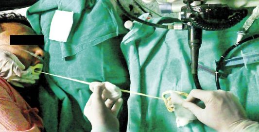 India: médicos extraen por la boca de un paciente una lombriz solitaria de 1,85 metros