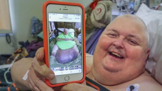 Le extirparon un tumor de 59 kilos que se originó por "un pelo encarnado"