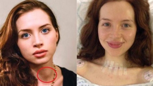 Una madre descubrió que su hija tenía cáncer de tiroides al ver un pequeño bulto en su cuello en una foto