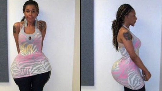 EE.UU.: condenaron a una falsa médica por aumentar glúteos con cemento y pegamento