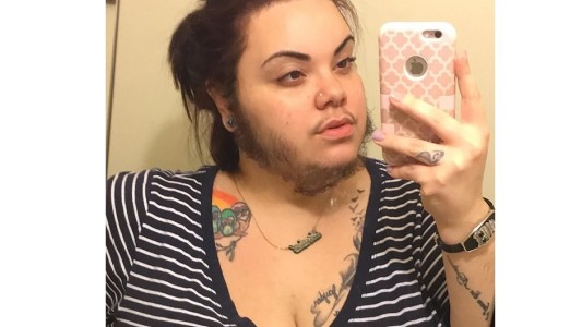 Cansada de los insultos decidió dejarse la barba, producto de un desorden hormonal