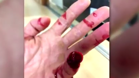 Policía pierde un dedo de la mano al ser mordido durante un control de alcoholemia