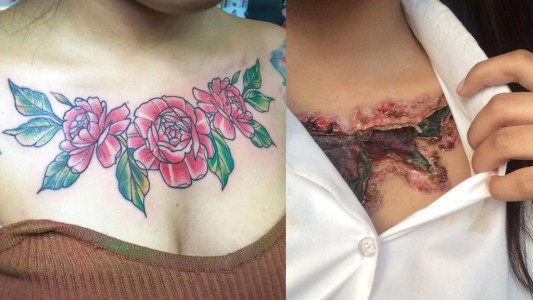 El calvario de una chica que intentó borrar en forma casera en tatuaje que tenía en el pecho