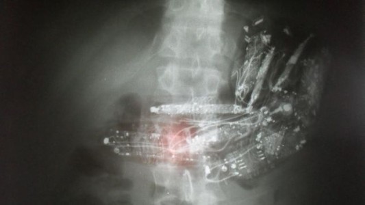 Descubrieron a tres presos con 19 celulares en el estómago y el recto