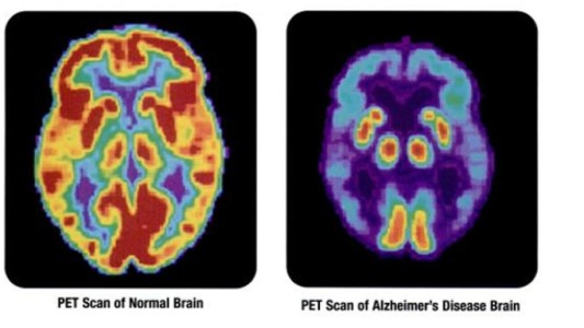 Descubren cómo detener y revertir el alzheimer y el parkinson