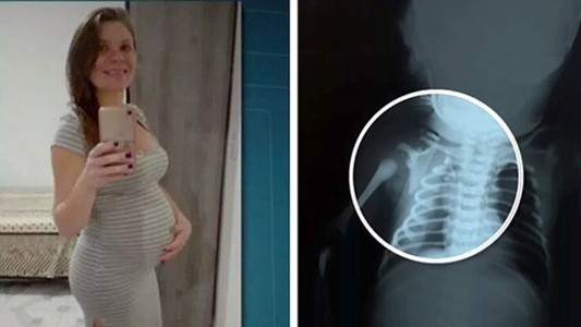 Este bebé fue baleado en el vientre de su mamá y logró sobrevivir