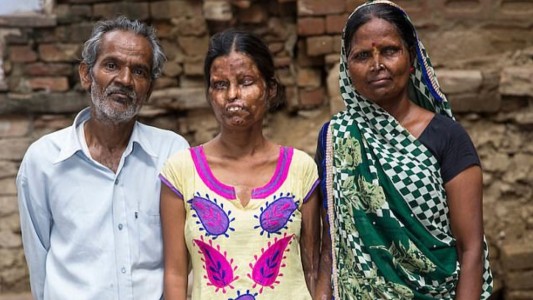 Una mujer volvió a vivir con su el hombre que le tiró ácido en la cara, dejó ciega a una de sus hijas y mató a la otra