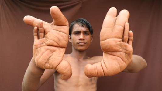 El extraño caso del chico indio al que no le paran de crecer las manos