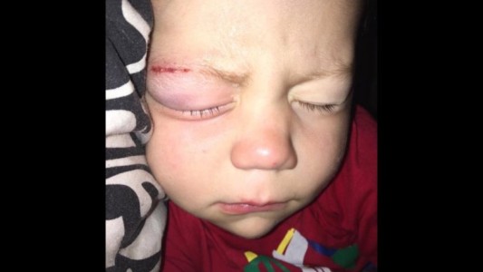 Indignante: llevaron a un nene al hospital y por un error médico le pegaron los ojos con pegamento