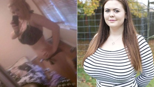 El drama de la joven a la que no le paran de crecer los pechos