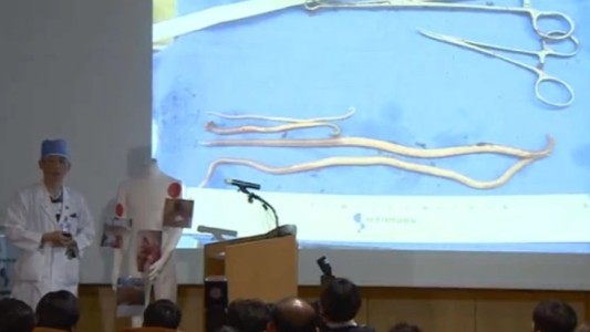 Al soldado norcoreano que desertó le extrajeron una lombriz intestinal de 27 centímetros de largo