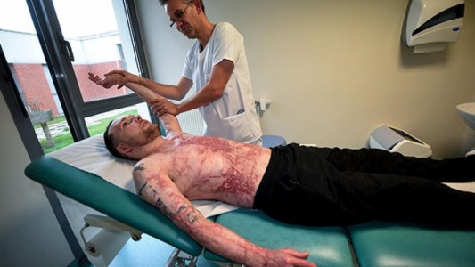 Tiene el 95% del cuerpo quemado y su hermano gemelo le donó el 50% de su piel