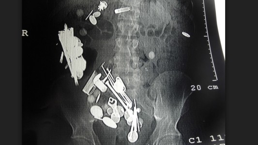 El extraño caso del hombre con depresión que se comió 263 monedas, 150 clavos y una correa para perros