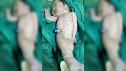Nació un "bebé sirenita en la India, pero sólo sobrevivió unas horas