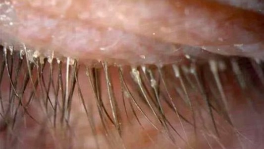 El extraño caso de la mujer china a la que le hallaron 100 parásitos en el ojo