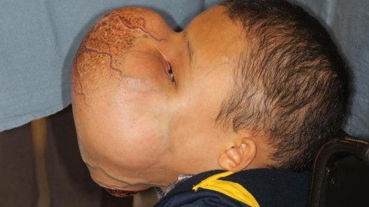 Cirujanos de Miami extirparán este tumor facial de 4,5 kilos a un niño cubano
