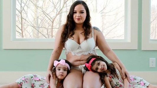 La mujer que ama sus estrías: "Tenía que pasar para tener a mis hijas acá"