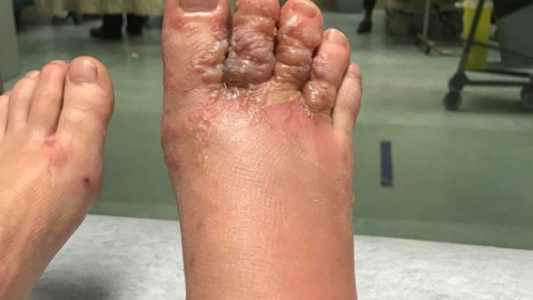 Una pareja viajó a República Dominicana y volvió con un parásito que "devoraba" sus pies