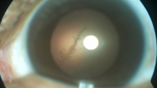 Le sacaron del ojo un gusano "come cerebros"