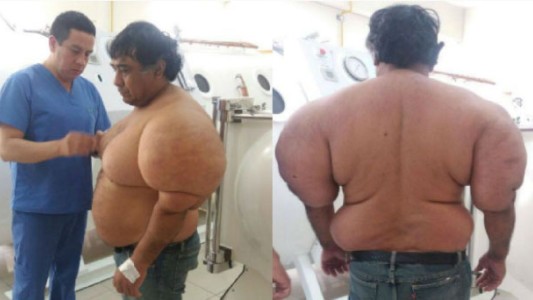 El extraño caso del buzo al que se le deformó el cuerpo después de un accidente con nitrógeno