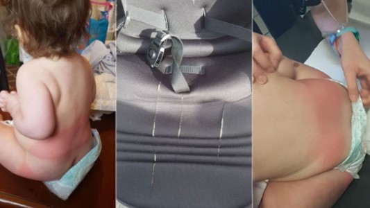 Conmoción en Francia: atacaron con ácido a una bebé de 14 meses