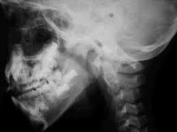 Fue al hospital por dolores de cabeza: tenía una bala alojada en el cráneo