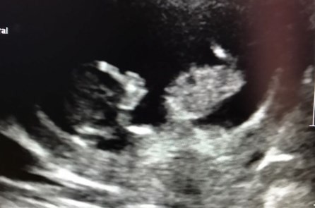 La extraña ecografía que se hizo viral en Twitter: ¿un bebé fumando un cigarrillo?