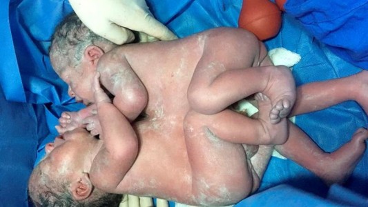 Separaron con éxito a siameses unidos por el tórax y el abdomen
