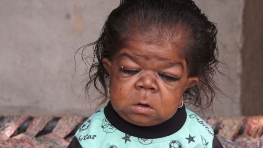 El terrible caso de un joven de 23 años atrapado en un cuerpo de bebé