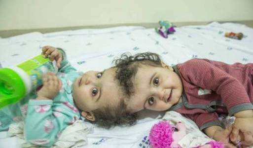 Lograron operar con éxito a las siamesas brasileñas María Ysabelle y María Ysadora