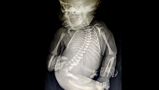 Una mujer dio a luz a un "bebé sirena" que sólo vivió quince minutos