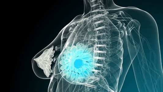 Estados Unidos: consiguen eliminar una metástasis de cáncer de mama por primera vez