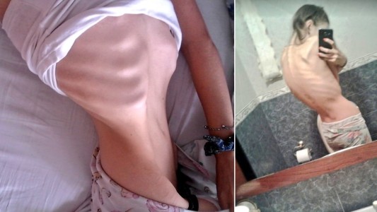 Publicó sus fotos para mostrar el peligro del "body checking"