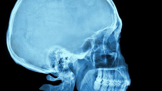 Hallan 100 huevos de un parásito en el cerebro de una nena que sufría dolores de cabeza