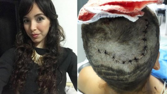 Colombia: un hombre le arrancó el cuero cabelludo a su ex pareja