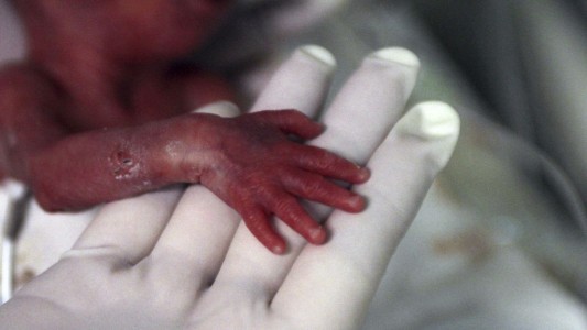 Milagro en Barcelona: nació un bebé a las 28 semanas que pesa 545 gramos