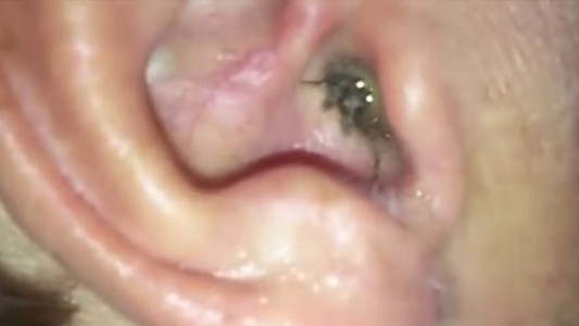 Descubrimiento escalofriante: tenía una araña en el interior del oído