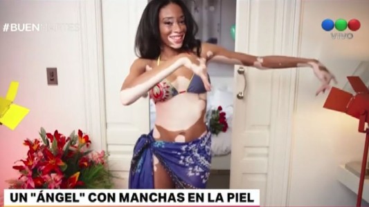 Contratan a una modelo con vitiligo para desfilar en ropa interior