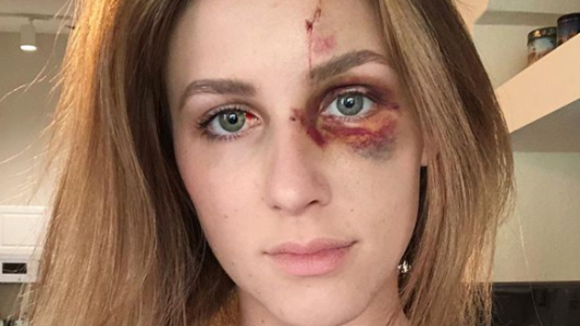 Un campeón de motocross golpeó brutalmente a su novia tras quejarse por una foto que subió a Instagram